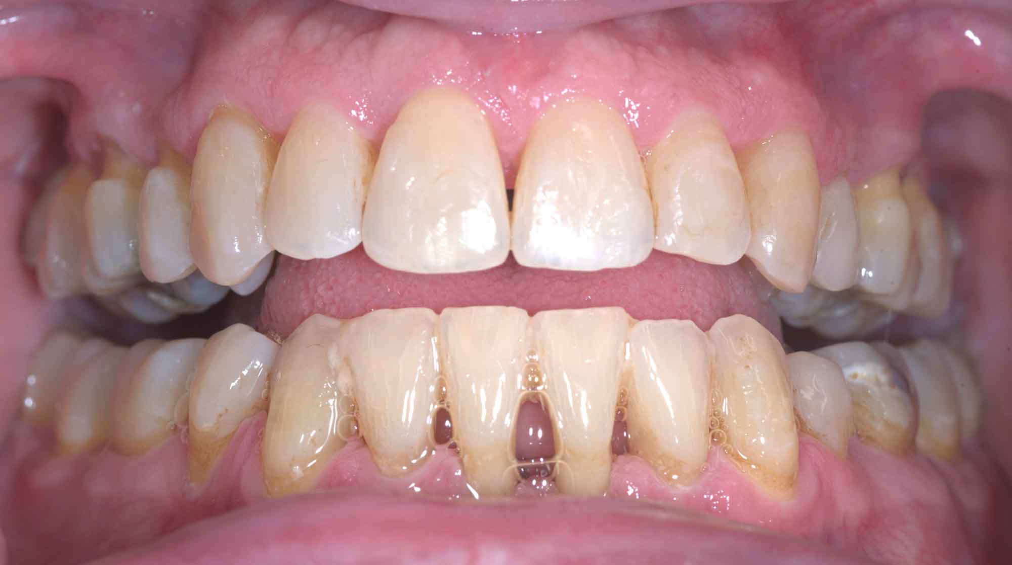 Second example after Invisalign