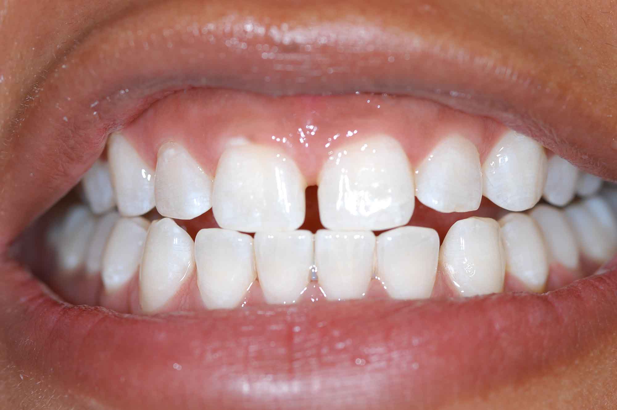 Second example after Whitening