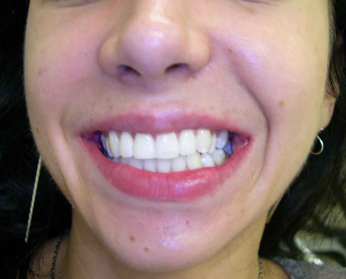 After whitening