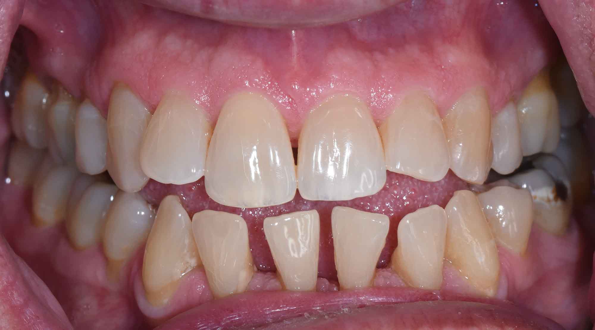 Second example before Invisalign