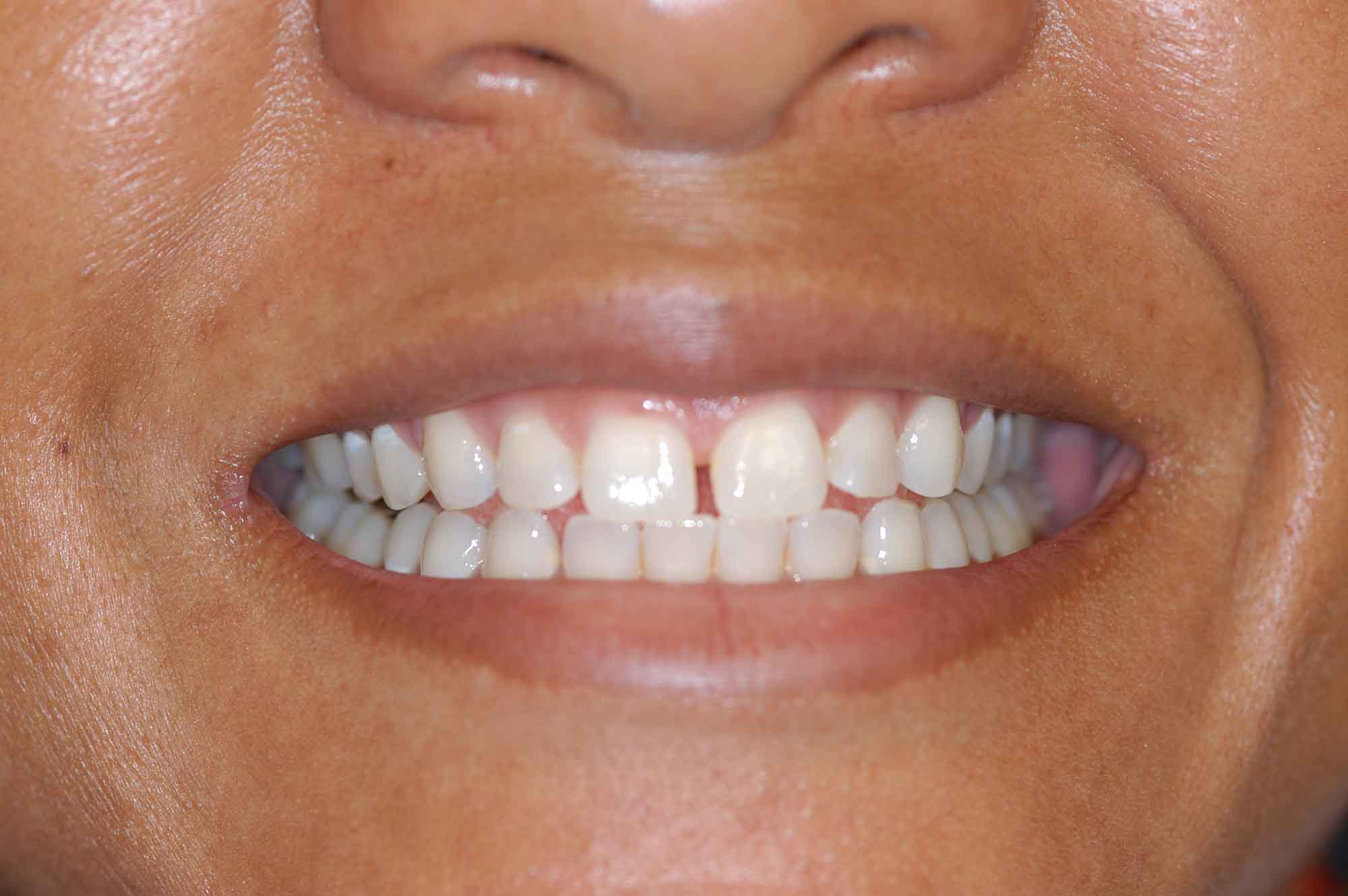 Second example before whitening